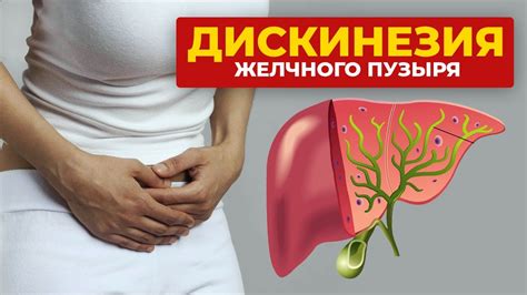Дискинезия желчного пузыря. Как лечить? Причины и симптомы - YouTube