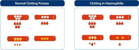 Understanding Haemophilia