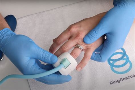 Image result for Ring Removal String Technique