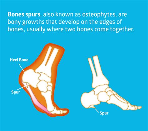 How to Treat Bone Spurs The Natural Way | AlgaeCal