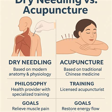 How Dry Needling Differs from Acupuncture Approaches | Aiello Family Chiropractic