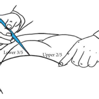 E28 Shuidao punto acupuntura del meridiano del estomago