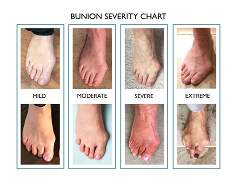 Best 13 What Is Bunion Surgery Recovery Time – Artofit