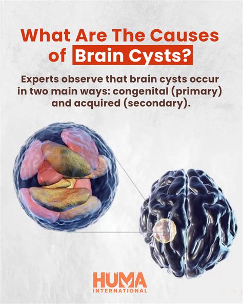 Can Brain Cyst Kill You