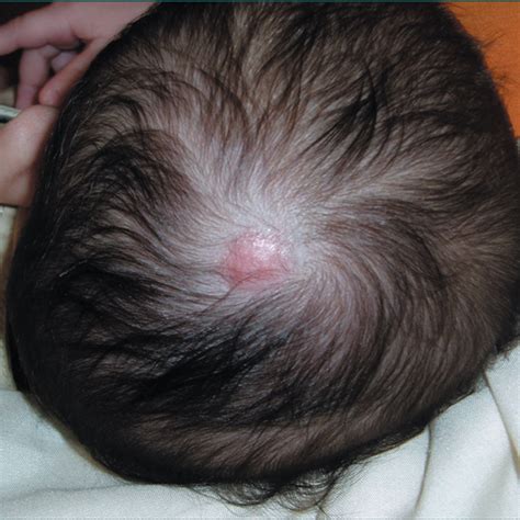 Effective Repair and Management of Severe Scalp Avulsion Sustained ...