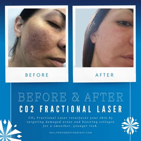Co2 Fractional Laser
