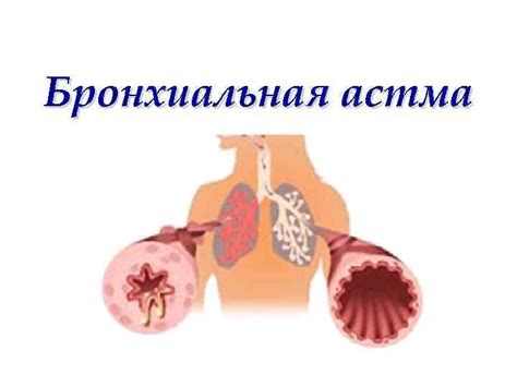 Бронхиальная астма План лекции Определение эпидемиология