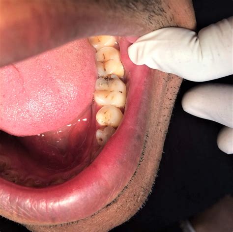 Cómo quitar las caries y cómo prevenirlas | Smysecret
