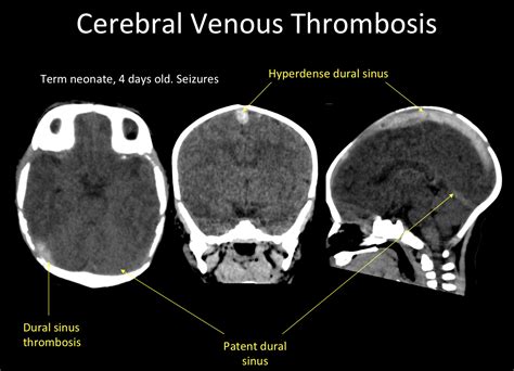 Superior Sagittal Sinus Thrombosis