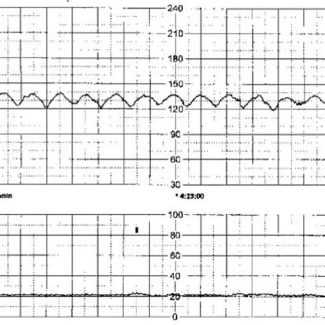 (PDF) Sinusoidal fetal heart rate pattern: Its definition and clinical ...
