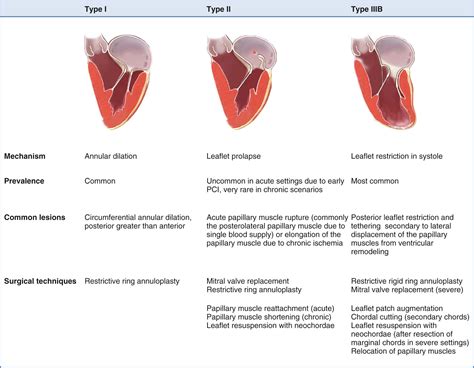 Ischemic Mitral Regurgitation – Clinical Tree