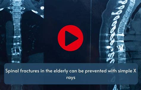 Spinal fractures in the elderly can be prevented with simple X-rays