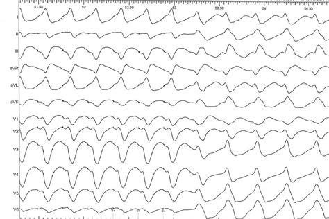 Mapping fundamentals, electrograms and entrainment