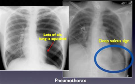 Image result for Deep Sulcus Sign