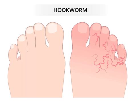 Hookworm Infection: Causes, Symptoms & Prevention