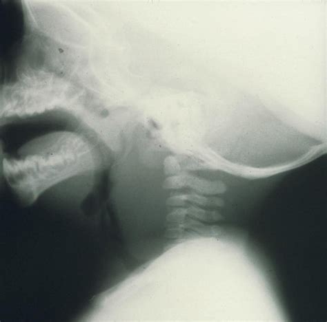 Retropharyngeal Abscess - Retropharyngeal Abscess - MSD Manual ...