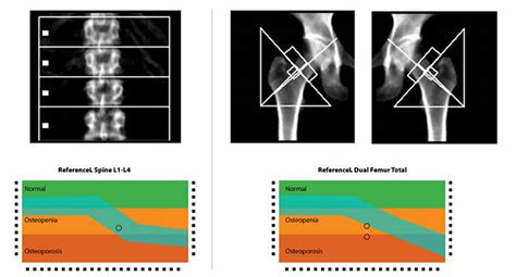 Image result for Dexa Scan Interpretation