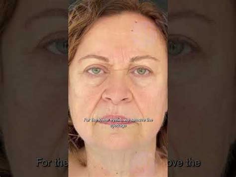 Understanding the Different Techniques of Blepharoplasty