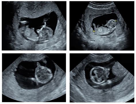 Agnathia-Otocephaly Complex Due to a De Novo Deletion in the OTX2 Gene