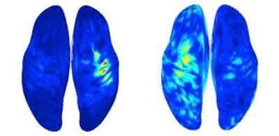 Cause of phantom limb pain in amputees, and potential treatment, identified
