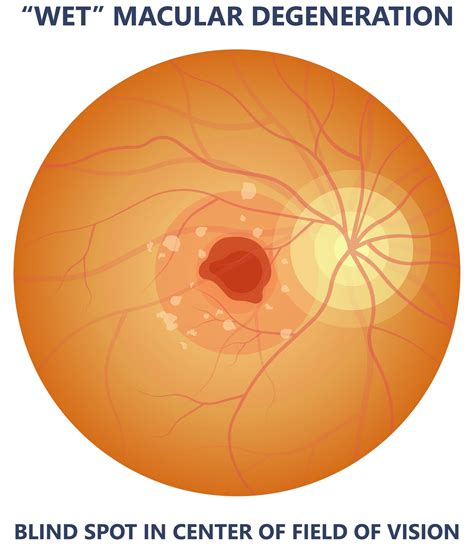 Macular Degeneration - Diagnosis & Treatment | Optimal Vision