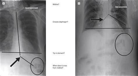 Diagnosis and Management of a Misplaced Nasogastric Tube Into the ...