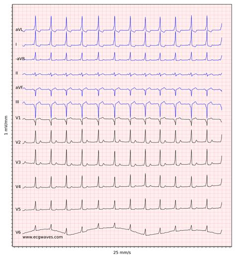 Pre-excitation, Atrioventricular Reentrant (Reentry) Tachycardia (AVRT), Wolff-Parkinson-White ...