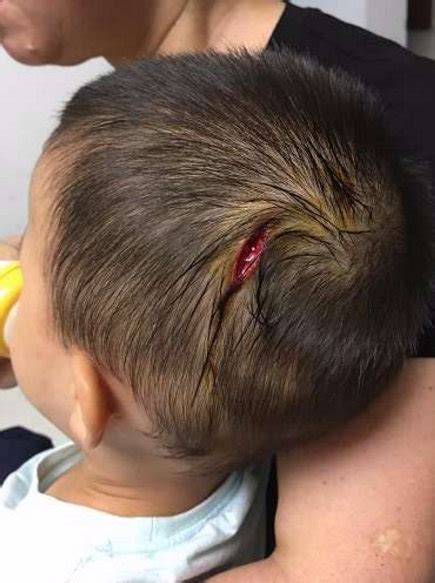 2岁男孩遭成年男子踢头部缝5针 肇事者被抓获|警方|男子|头部_新浪新闻