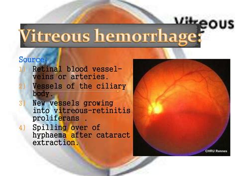 PPT - Vitreous Anatomy & Diseases: Understanding Symptoms, Causes, and Treatment Options ...
