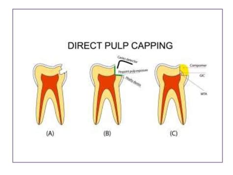 Image result for Difference Between Direct and Indirect Pulp Capping