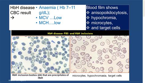 Alfa thalassemia syndromes | PDF