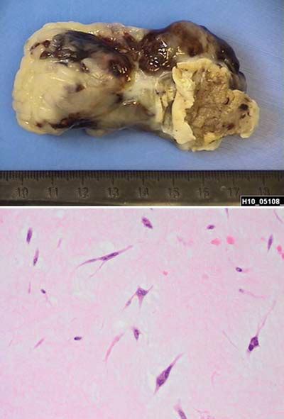 A Large Atrial Myxoma in a Patient Presenting with Paroxysmal Atrial ...