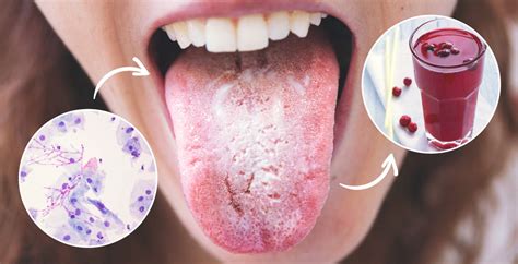 Bildergebnis für candida hiivasieni