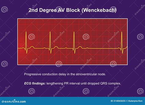 ECG of 2nd Degree AV Block Wenckebach , 3D Illustration Stock ...