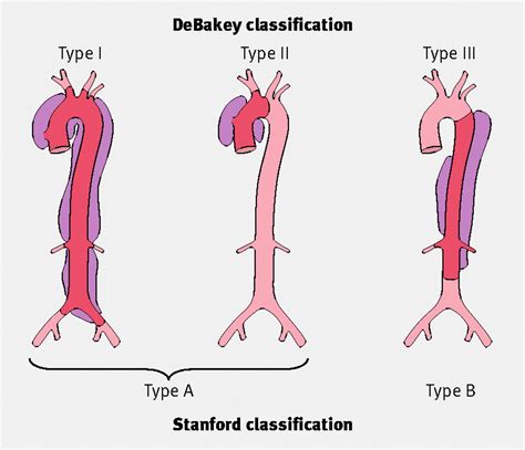 Acute aortic dissection | The BMJ