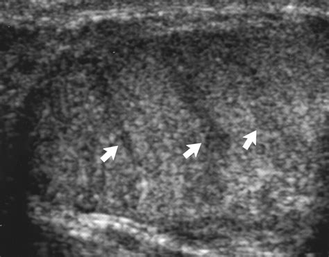 Anatomy Of Testis Ultrasound at Jason Burchfield blog