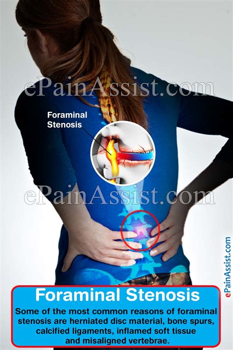 Foraminal Stenosis|Treatment|Causes|Symptoms|Types