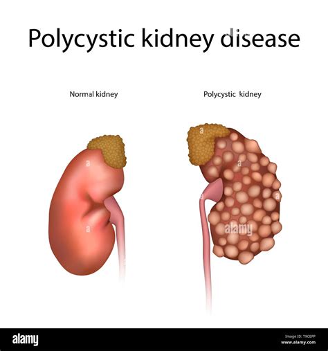 Early Signs Of Polycystic Kidney Disease – EHTN