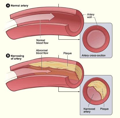 Image result for Calcium Buildup Signs