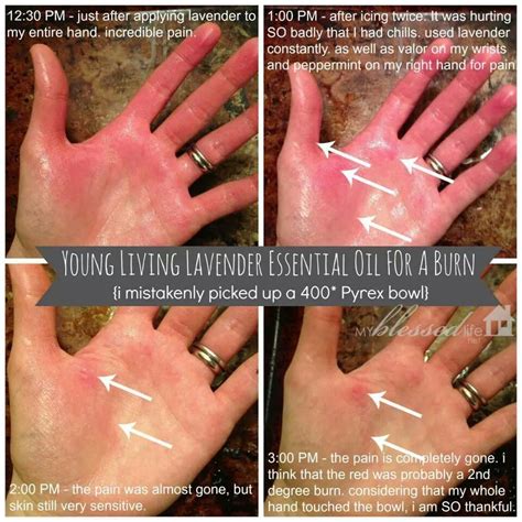 essential oils for 2nd degree burns