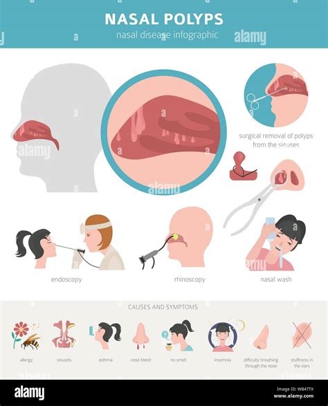 Nasal polyps hi-res stock photography and images - Alamy