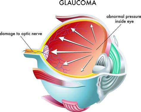 Glaucoma surgery | Advanced Glaucoma Surgery in Australia | Mary River Eye Specialists