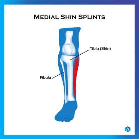 Shin Splints | Dr. Abbie Clinics