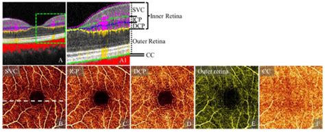 Review of Artifacts and Related Processing in Ophthalmic Optical ...