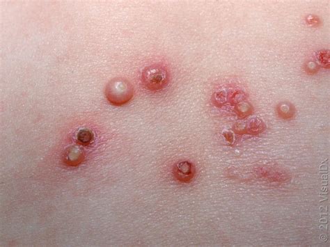 See related image detail. 11 Common Rashes on Kids and Preschoolers (With Images) - GoodRx