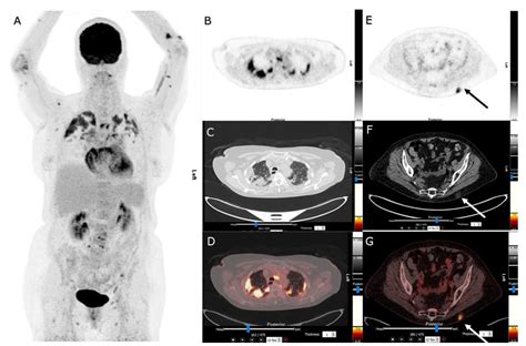 COVID-19-Associated Erythema Nodosum Detected on FDG PET/CT