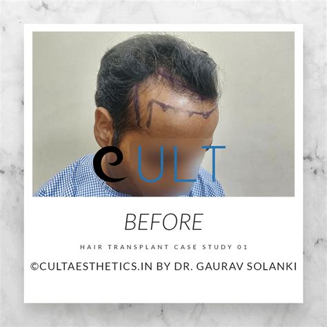 Hair Transplant Results 01Cult Aesthetics
