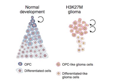 Childhood Glioma Program | Dana-Farber Cancer Institute