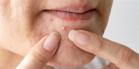 Image result for Exploding Zit Videos 2013