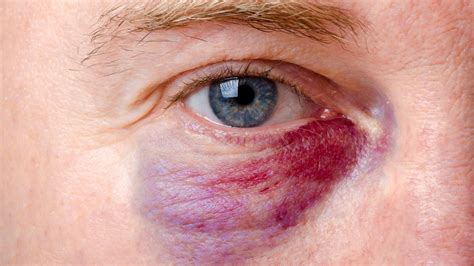 Hyphema: Causes, Symptoms, Diagnosis & Treatment
